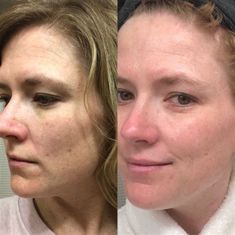 Jun 5, 2018 ... Hello, WORLD! This is my first 3 month Tretinoin cream review. See my skin before and after Retin-a application and learn how to use Retin-a ...